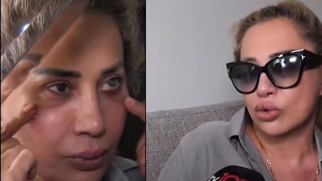 Göz bebeği çürüdü, gözü maviye döndü! Estetik ameliyatında kabusu yaşadı... 8,5 aydır karanlık odadan çıkamıyor