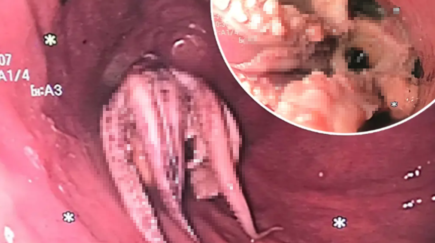 Sürekli olarak kusan hastanın boğazından ahtapot çıktı! Doktorları bile şaşkına çevirdi...