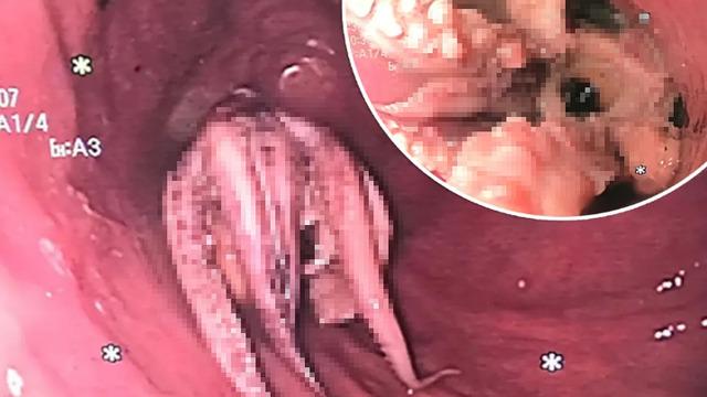 Sürekli olarak kusan hastanın boğazından ahtapot çıktı! Doktorları bile şaşkına çevirdi...