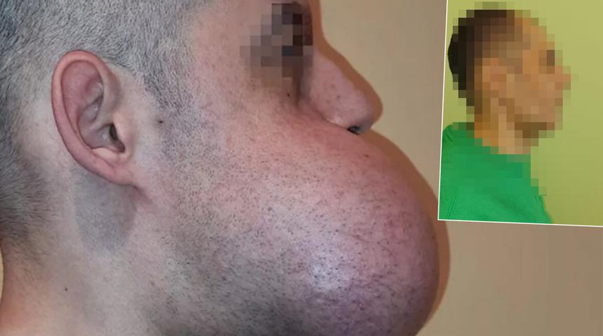 Yemek yiyemiyor, nefes dahi alamıyordu! 8 saatlik operasyonla tümör alındı... Yüzü yeniden inşa edildi