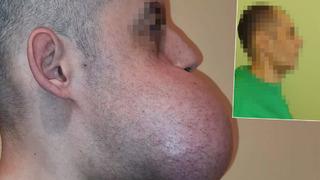 Yemek yiyemiyor, nefes dahi alamıyordu! 8 saatlik operasyonla tümör alındı... Yüzü yeniden inşa edildi