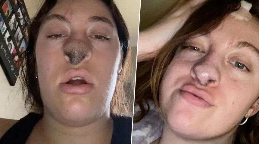 Köpek saldırısından sonra burnuna deri nakli yaptırdı! “Burnumun üzerinde tüyler çıkmaya başladı”