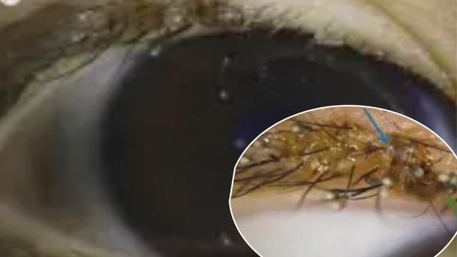 3 yaşındaki çocuğun kirpiklerine bit yuva yaptı! Görüntüler herkesi şaşkına çevirdi