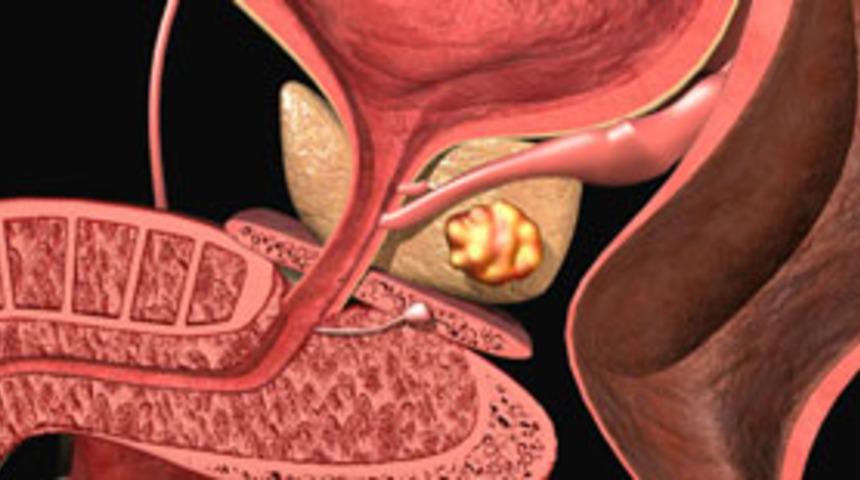 Prostatta 'Brakiterapi'nin tercih sebebi