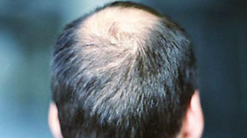 Saç ekiminde teknoloji desteği