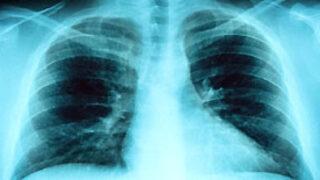 Türkiye'de 3 milyon akciğer hastası var