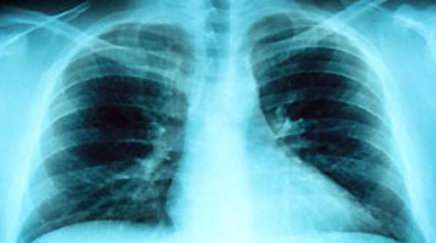Akciğer kanseri tedavisinde yeni yöntemler