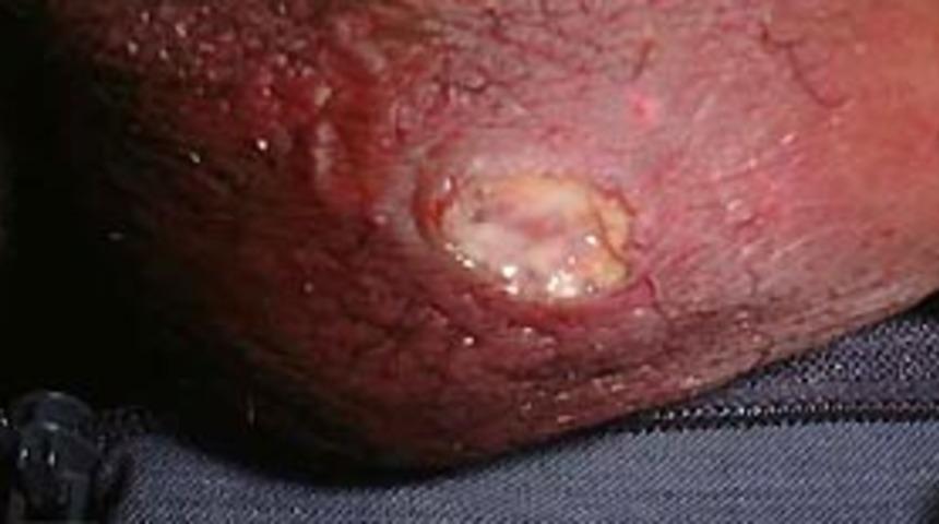 Behçet Hastalığını biliyor musunuz?