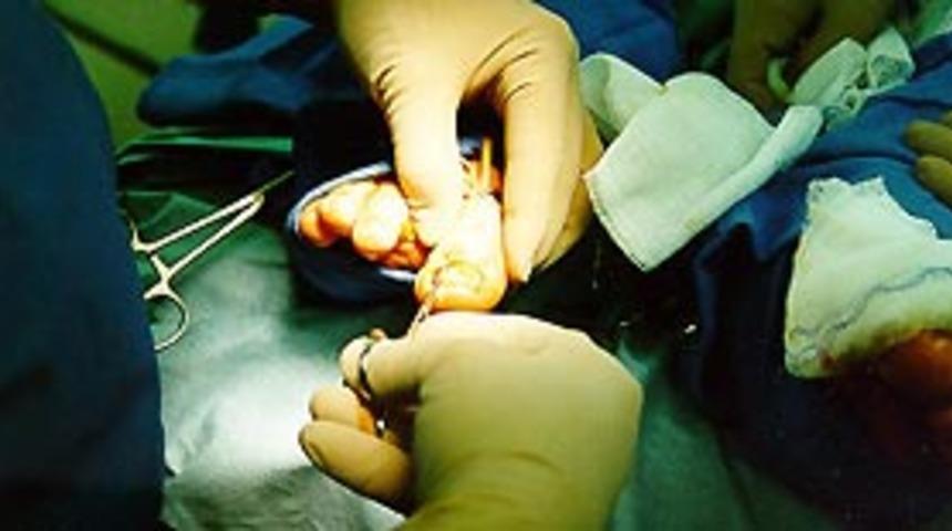 Tırnak batmasının sebepleri