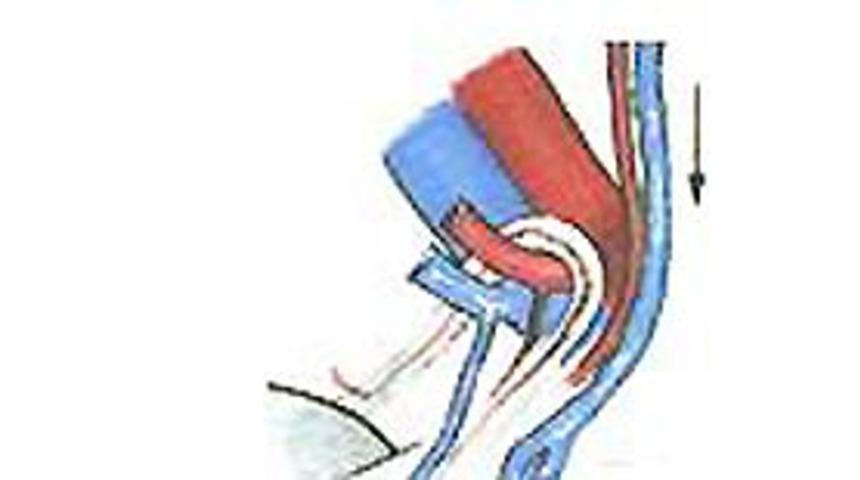 Varikosel Nedir? Nasıl Tedavi Edilir?