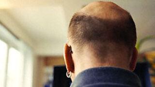 Kellerin yeni umudu lazer saç tarağı