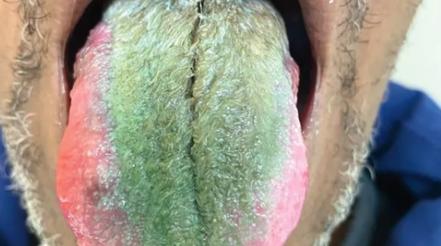 Doktorları bile şaşkına çevirdi! Dili bir anda yeşil renge döndü ve tüylenmeye başladı... 