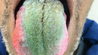 Doktorları bile şaşkına çevirdi! Dili bir anda yeşil renge döndü ve tüylenmeye başladı... 