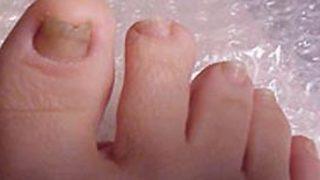 Ayak mantarı hakkında merak ettikleriniz