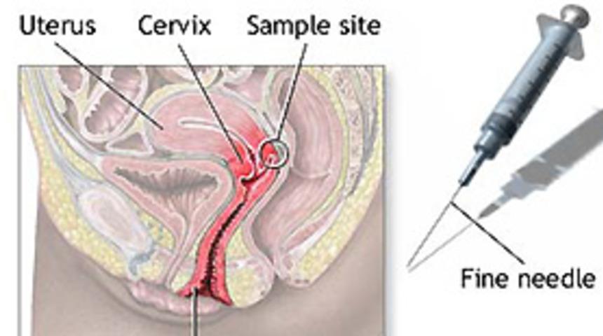 Rahim kanseri aşısı çıkıyor