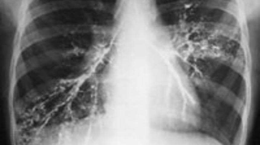 Akciğer kanserinin diğer nedenleri