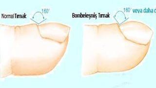Parmaklarınızda çomaklaşma var mı?