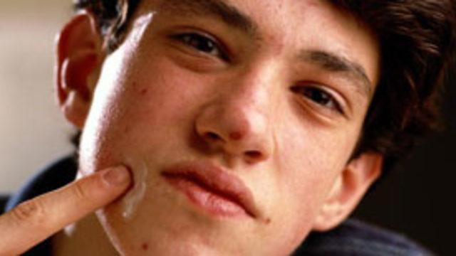 Dudak kenarındaki uçuklara dikkat