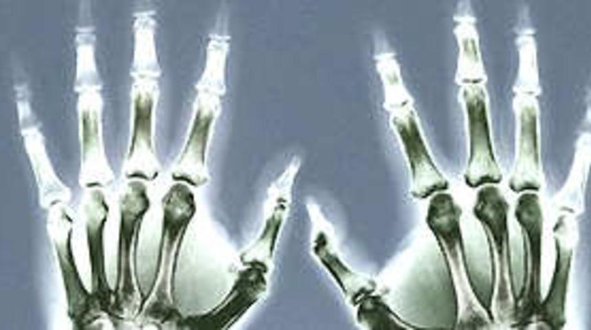 Osteoporoz önlenebilir