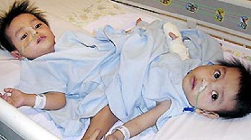 Endenozyalı ikizlerin sağlık durumu iyi