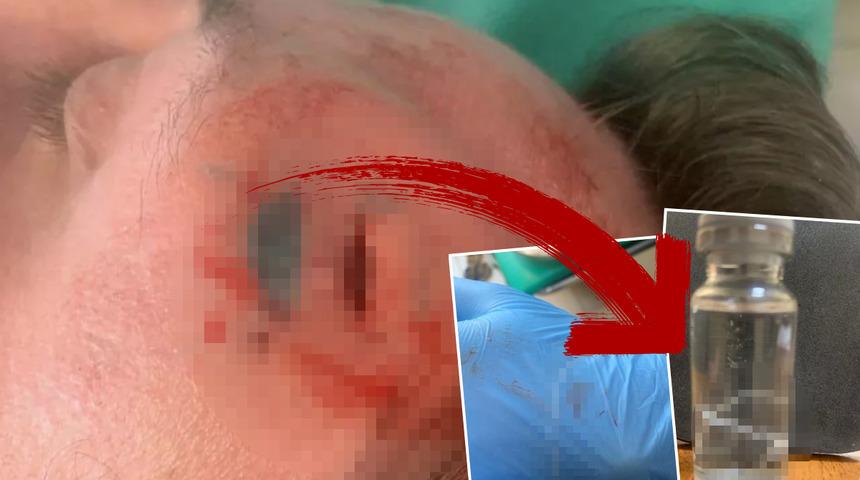 Sürekli olarak başı ağrıyordu! Alnından 15 cm’lik solucan çıkınca doktorları bile şaşkına çevirdi