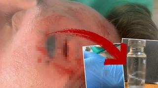 Sürekli olarak başı ağrıyordu! Alnından 15 cm’lik solucan çıkınca doktorları bile şaşkına çevirdi