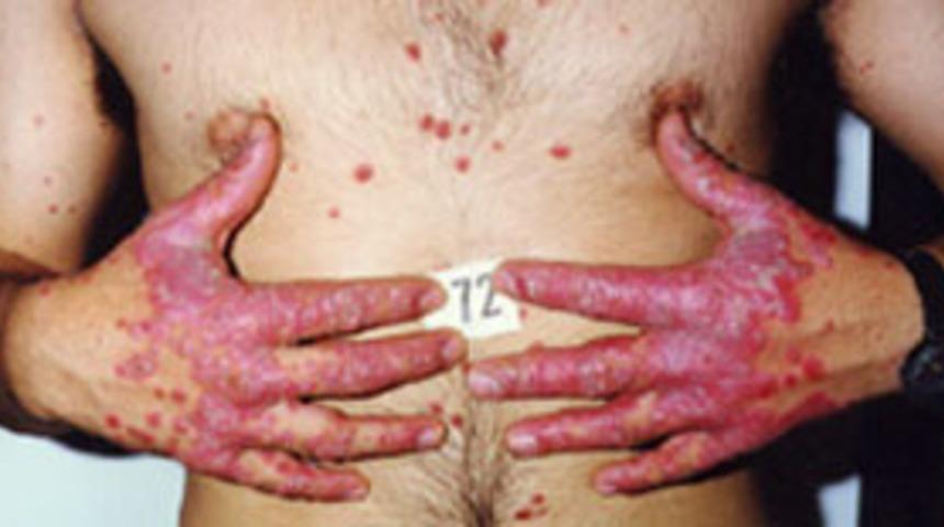 Sedef hakkında bilinmesi gerekenler