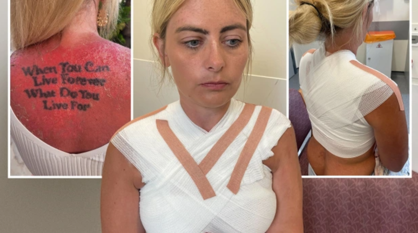 Tatili resmen kabusa döndü! Hava bulutlu olduğu için güneş kremi sürmeyince hastanelik oldu