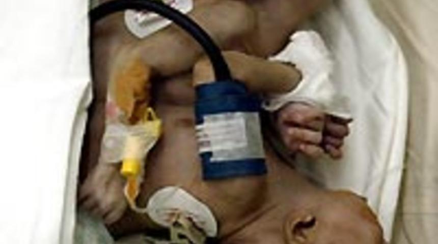 Kalpleri yapışık ikizler ayrılacak