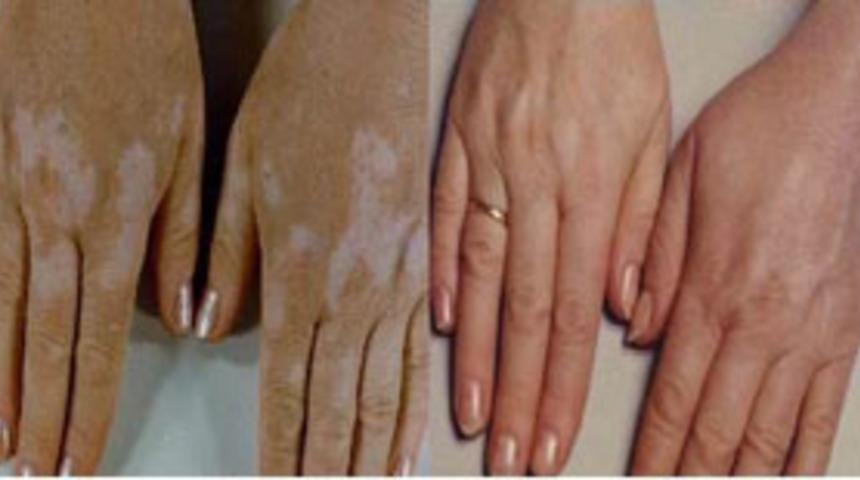 Vitiligo tedavisinde Bclear devri