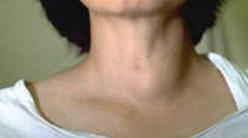 T&uuml;rkiye'de 6 milyon guatr hastası var