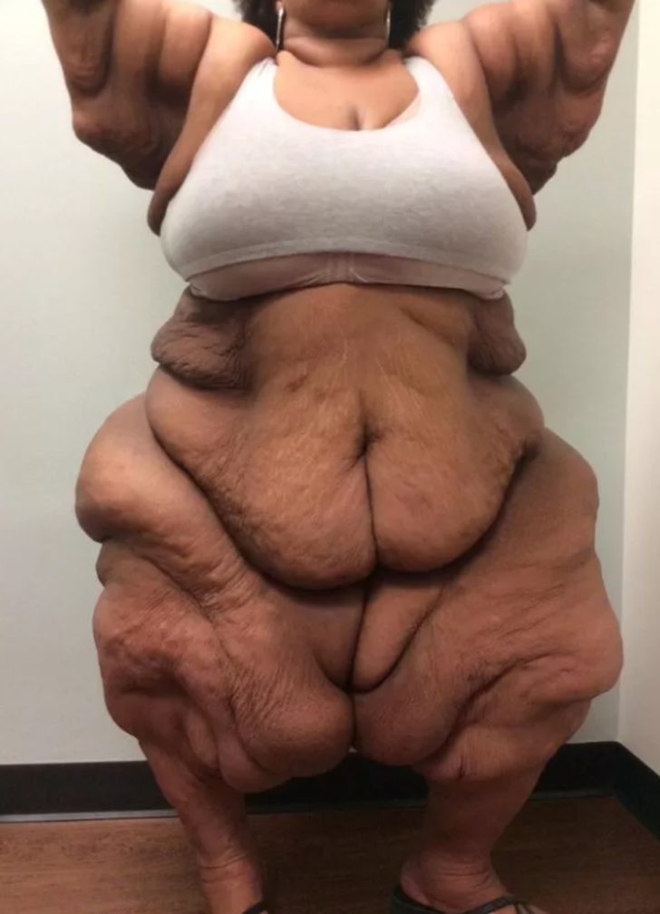 Dünyanın en şişman kadınlarından biriydi! Odasından vinçle taşınmak zorunda kalmıştı... Son hali inanılmaz G4