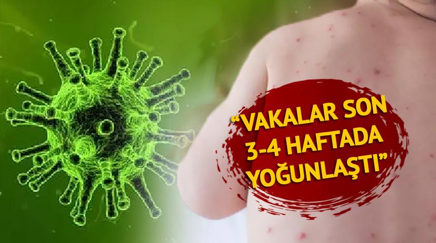 Vakalar en çok İstanbul'da! Avrupa yakasında tehlike daha fazla...  'Kızamık için korkutan uyarı: Son 3-4 haftadır yoğunlaştı'