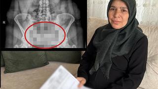 Ameliyat olduktan 8 ay sonra şiddetli karın ağrısı şikayetiyle başka bir hastaneye başvurdu, şoke eden gerçek ortaya çıktı!