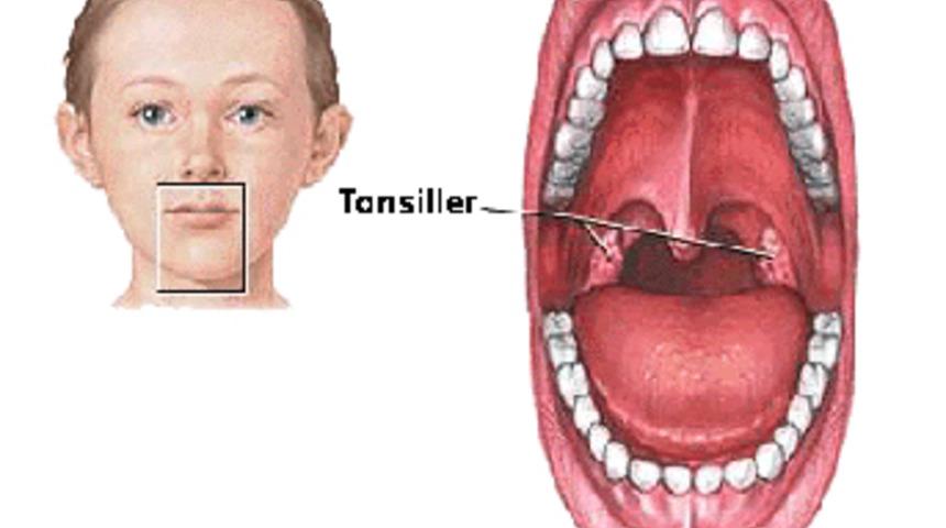 Bademcik ameliyatı kabusunuz olmasın!