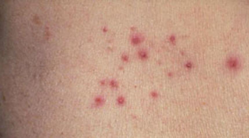 Gıda alerjilerine 10 yıl i&ccedil;inde son