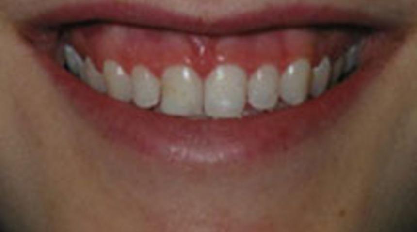 Diş Etlerim G&ouml;r&uuml;nmesin