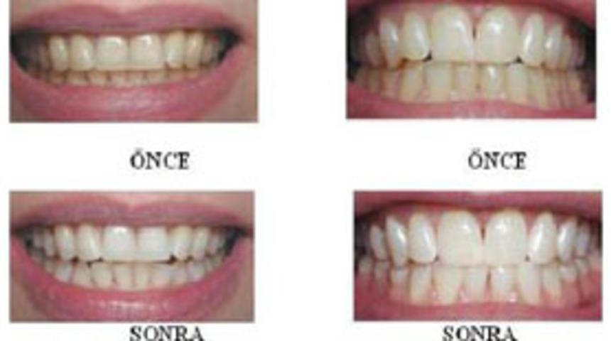 Diş Beyazlatma (Bleaching) teknikleri