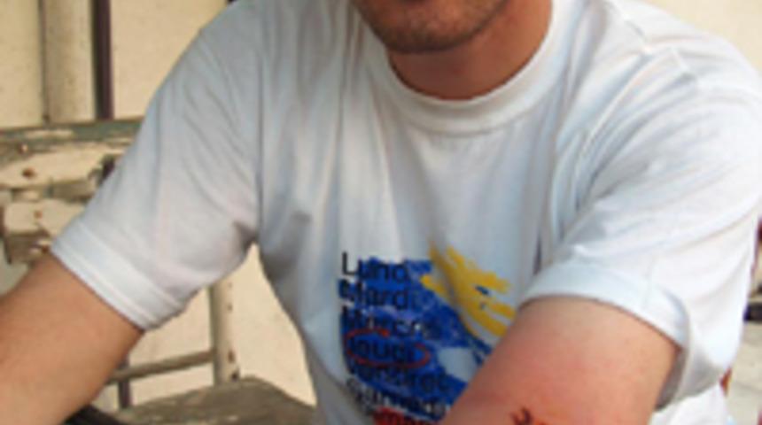 D&ouml;vme y&uuml;z&uuml;nden kolundan oluyordu