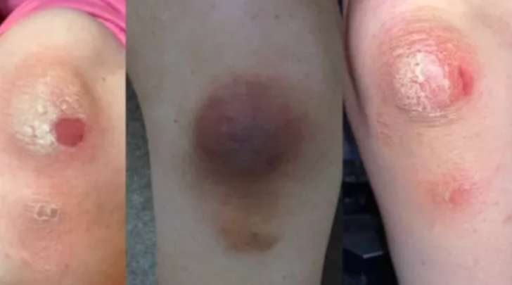 Semptomları korkunç! “İntihar hastalığı” teşhisi konuldu... Ağrıdan hareket dahi edemiyor G4