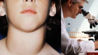 Tiroid (Guatr) bezi nedir? Tedavisi nasıldır?