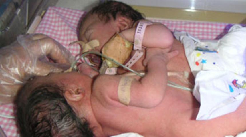 Antakya'da siyam ikizi d&uuml;nyaya geldi