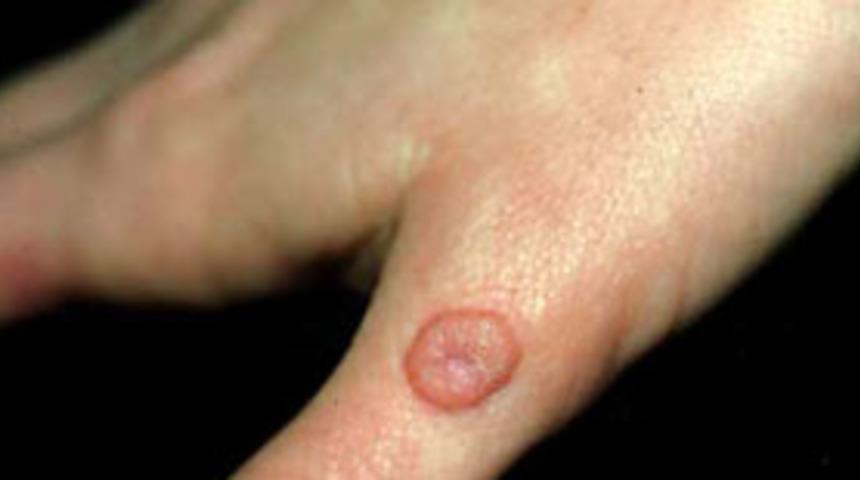 Siğil seyip ge&ccedil;meyin