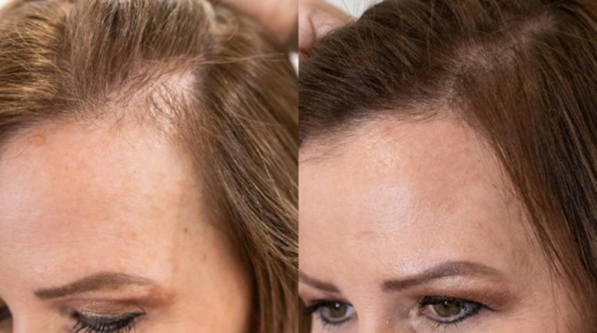 Saç dökülmesine son! Şampuana eklenen tek malzeme yeni saç çıkarıyor