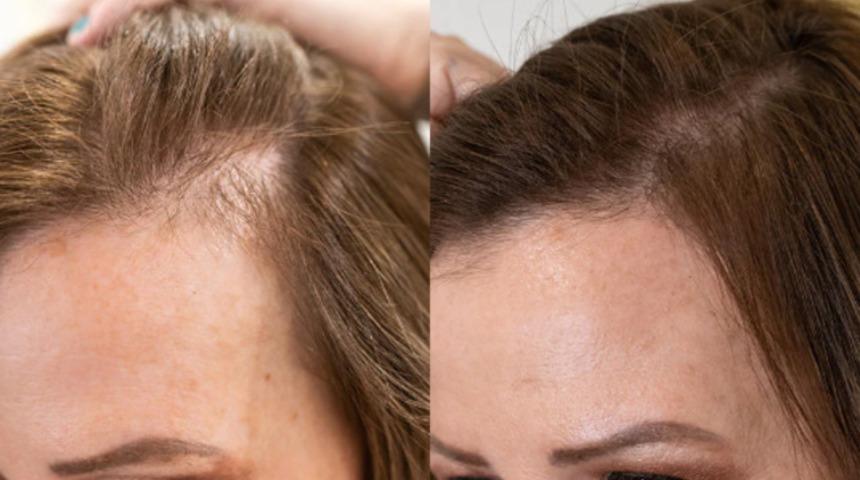 Saç dökülmeniz tarihe karışacak! Sadece 1 malzeme ile dökülen saçlarınızı yeniden çıkartın