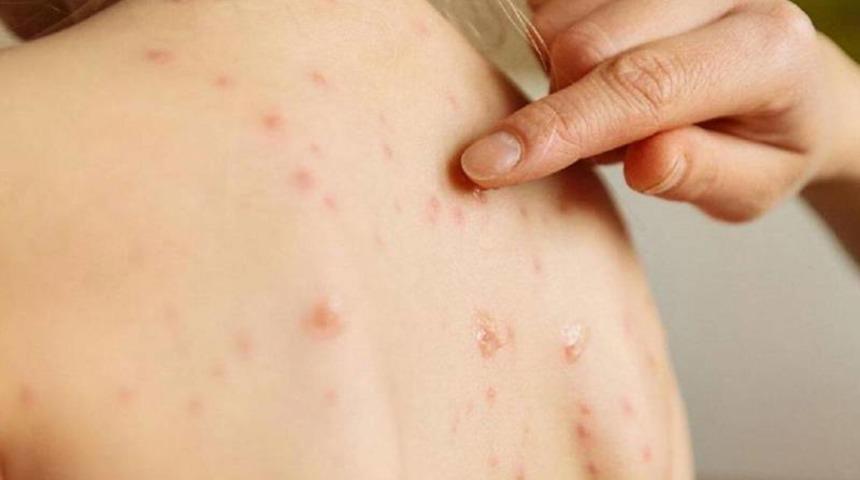 Prof. Dr. Şener'den hızla artan kızamık vakalarına karşı göçmen nüfus uyarısı! "Masum bir hastalık değil"