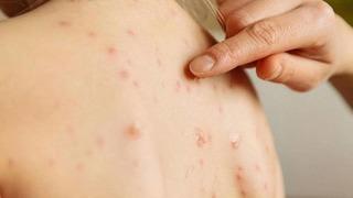 Prof. Dr. Şener'den hızla artan kızamık vakalarına karşı göçmen nüfus uyarısı! Masum bir hastalık değil