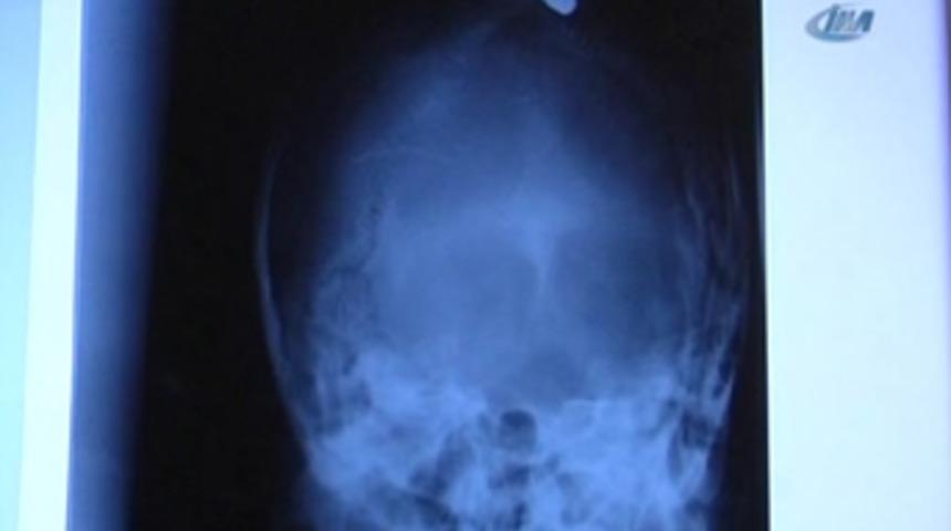 Damdan d&uuml;şt&uuml; sanıldı, kafasından mermi &ccedil;ıktı