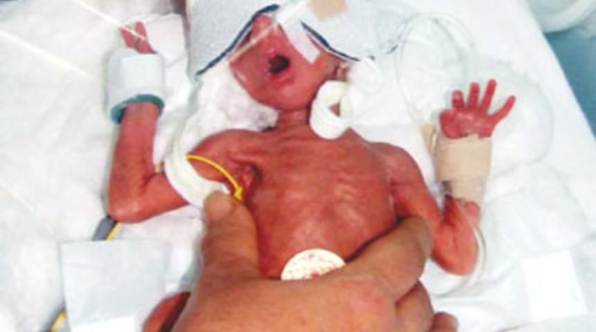 700 gramlık parmak bebeğin yaşam m&uuml;cadelesi