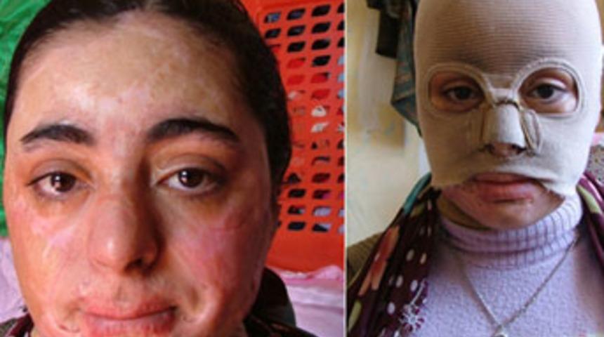 Kış aylarında yanık vakaları arttı